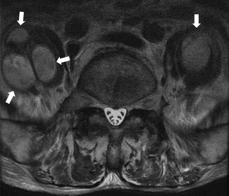 Prognostic nutritional index as outcome predictor in patients with iliopsoas abscess.