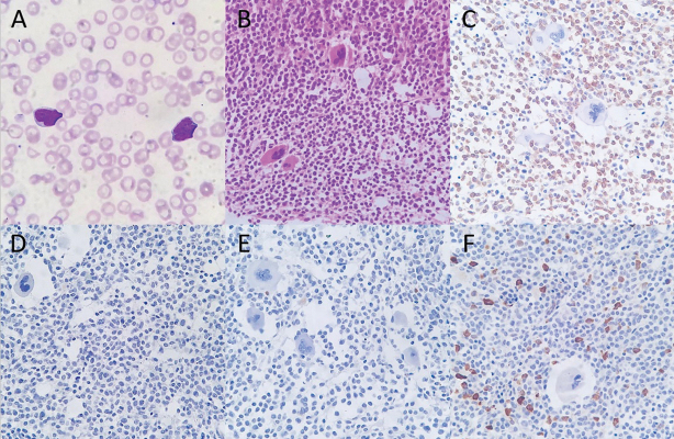 PAX5 and TDT-Negative B-Acute Lymphoblastic Leukemia with Unusual Genetic Mutations: A Case Report.