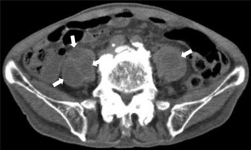 Prognostic nutritional index as outcome predictor in patients with iliopsoas abscess.