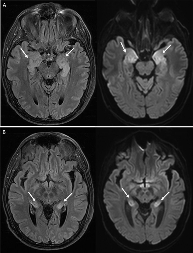 Human Herpesvirus-6 Encephalitis.