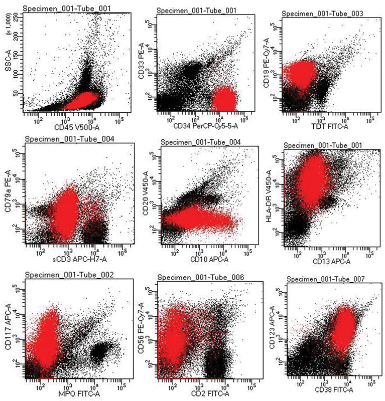 PAX5 and TDT-Negative B-Acute Lymphoblastic Leukemia with Unusual Genetic Mutations: A Case Report.