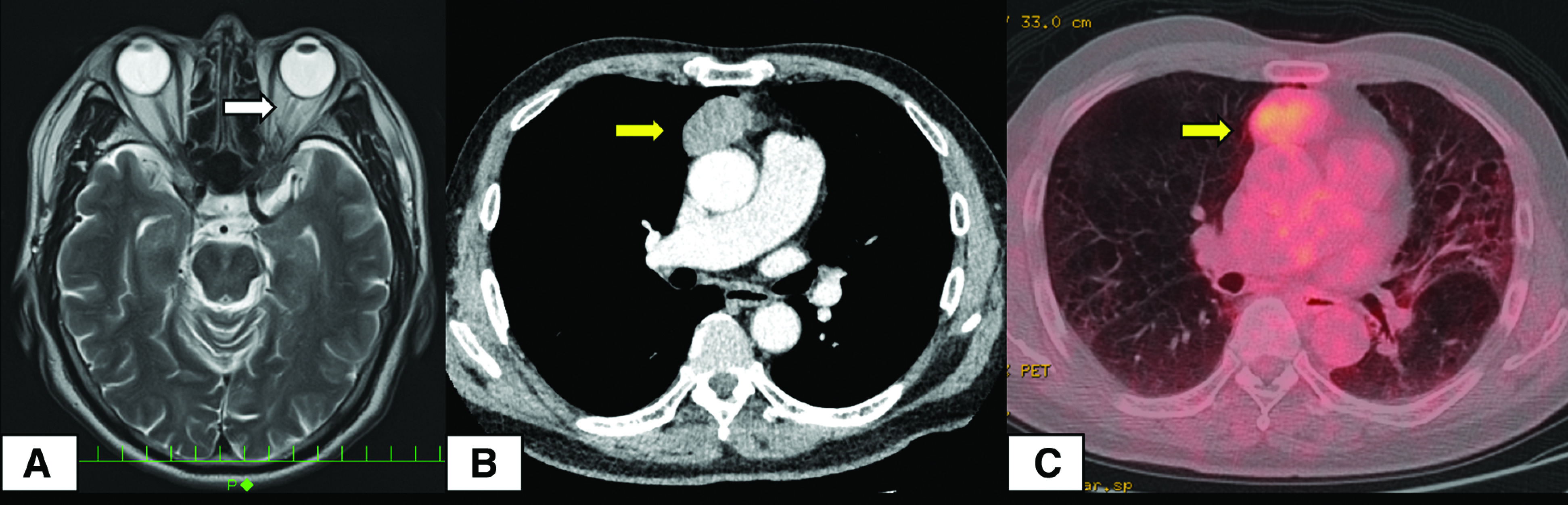 Paraneoplastic Neuromyelitis Optica Spectrum Disorder Associated with Atypical Thymic Carcinoid: A Case Report.