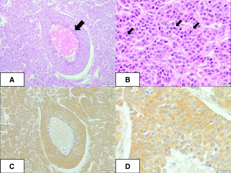 Paraneoplastic Neuromyelitis Optica Spectrum Disorder Associated with Atypical Thymic Carcinoid: A Case Report.