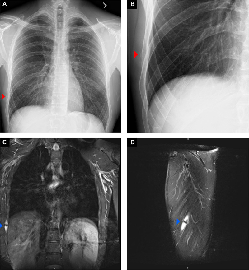 Rib Fractures in Professional Baseball Pitchers: Mechanics, Epidemiology, and Management.