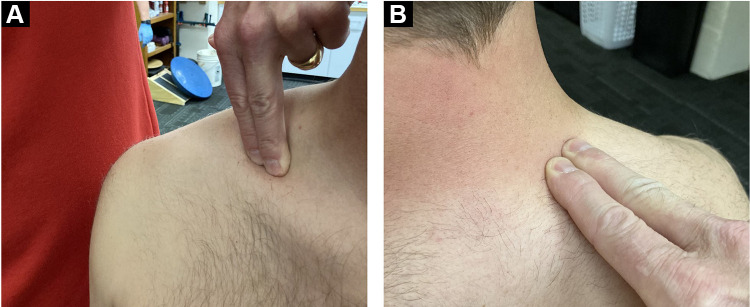 Rib Fractures in Professional Baseball Pitchers: Mechanics, Epidemiology, and Management.