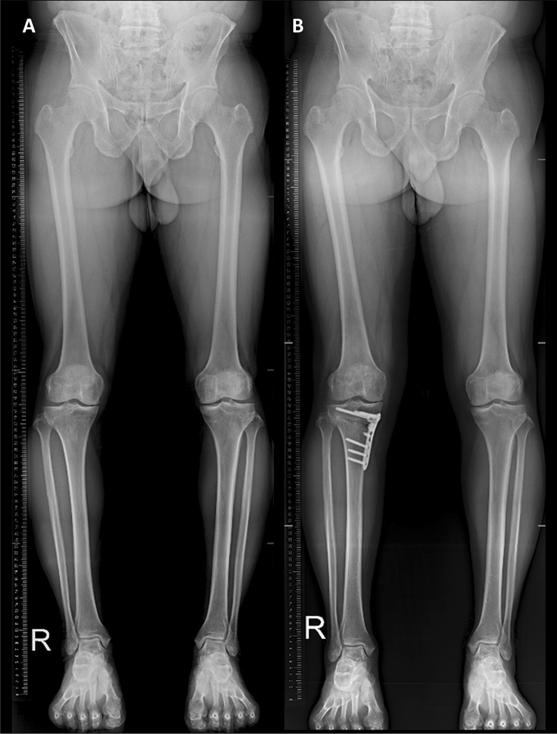 Effect of medial open wedge high tibial osteotomy on progression of patellofemoral osteoarthritis.