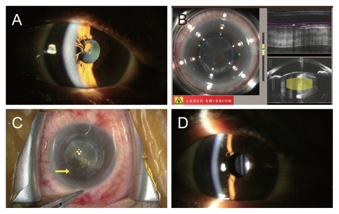 Successful Femtosecond Laser-assisted Cataract Surgery for a Cataract with Persistent Pupillary Membrane: A Case Report.