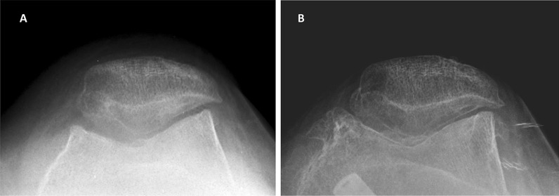 Effect of medial open wedge high tibial osteotomy on progression of patellofemoral osteoarthritis.