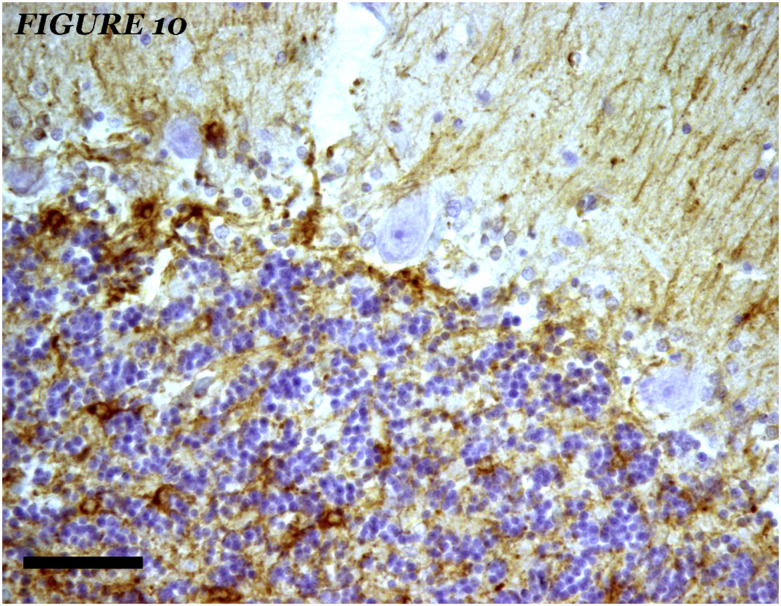 The relationships between neuroglial alterations and neuronal changes in Alzheimer's disease, and the related controversies I: Gliopathogenesis and glioprotection.