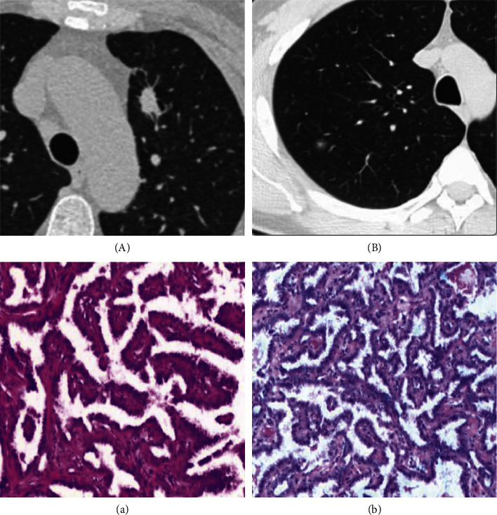 Feasibility of Using High-Resolution Computed Tomography Features for Invasiveness Differentiation of Malignant Nodules Manifesting as Ground-Glass Nodules.