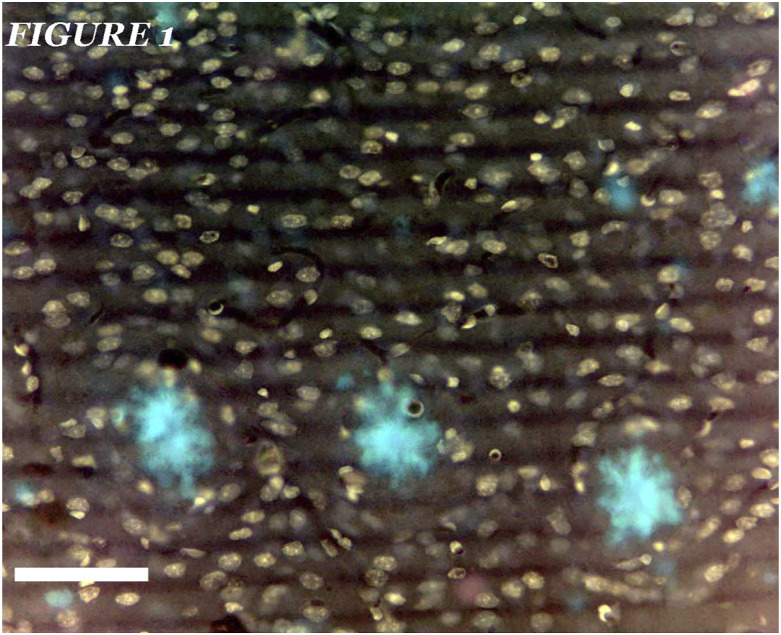 The relationships between neuroglial alterations and neuronal changes in Alzheimer's disease, and the related controversies I: Gliopathogenesis and glioprotection.