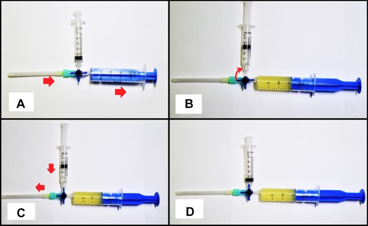 Using a Double Syringe Sterile System for MSK Aspiration/Injection Procedures Eliminates Risk of Iatrogenic Infection.