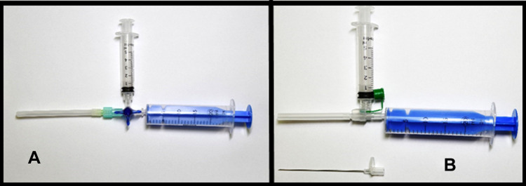 Using a Double Syringe Sterile System for MSK Aspiration/Injection Procedures Eliminates Risk of Iatrogenic Infection.