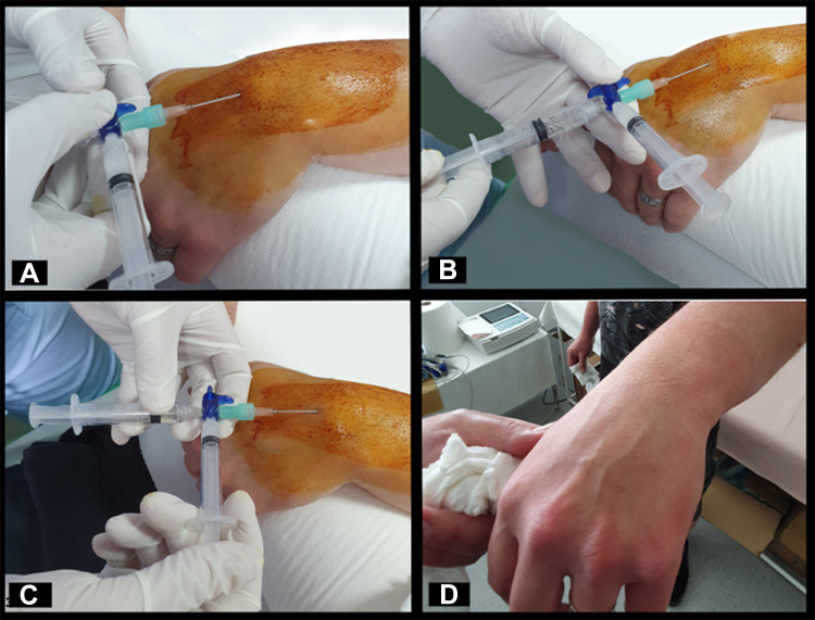 Using a Double Syringe Sterile System for MSK Aspiration/Injection Procedures Eliminates Risk of Iatrogenic Infection.