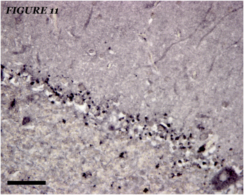 The relationships between neuroglial alterations and neuronal changes in Alzheimer's disease, and the related controversies I: Gliopathogenesis and glioprotection.