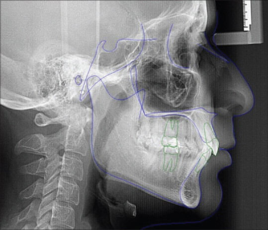 Comparison between Pre and Posttreatment Inclination of Maxillary Incisors in Adults: Association with Facial and Growth Axes.