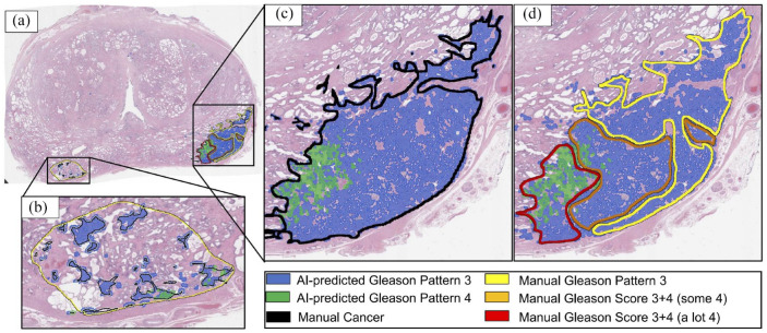 A review of artificial intelligence in prostate cancer detection on imaging.