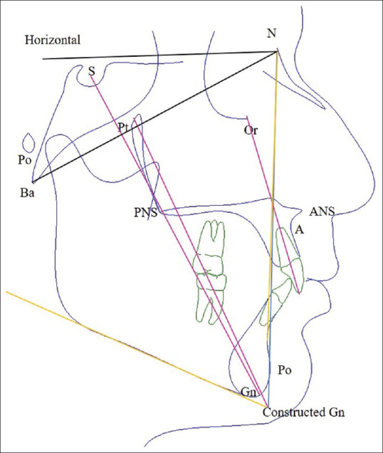 Comparison between Pre and Posttreatment Inclination of Maxillary Incisors in Adults: Association with Facial and Growth Axes.