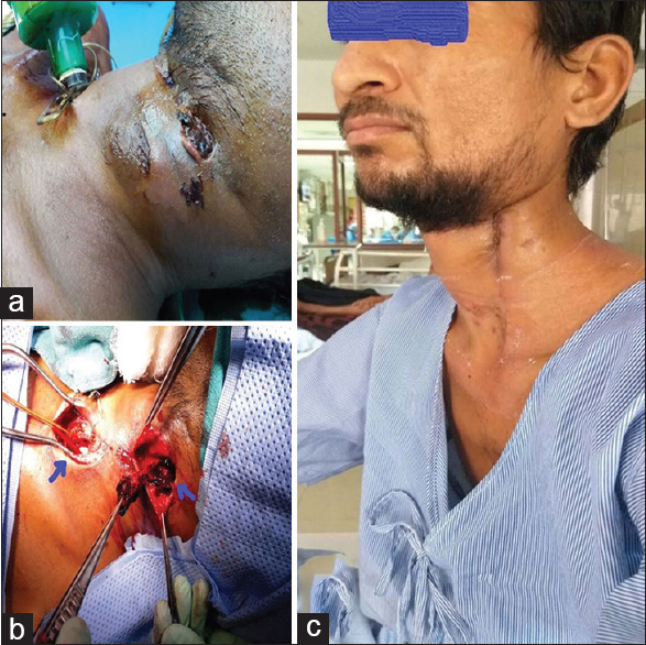 An Unusual Presentation of Ludwig's Angina with Empyema Thoracis and External Carotid Artery Pseudoaneurysm.