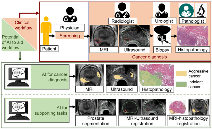 A review of artificial intelligence in prostate cancer detection on imaging.