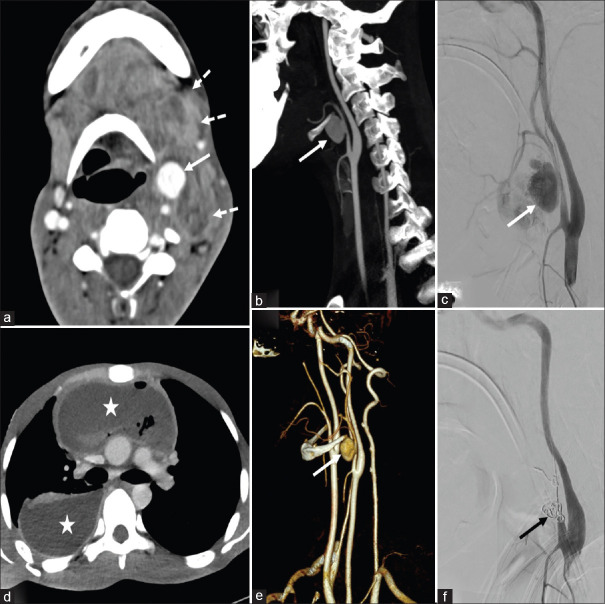 An Unusual Presentation of Ludwig's Angina with Empyema Thoracis and External Carotid Artery Pseudoaneurysm.