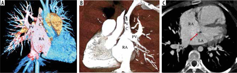 Partial anomalous pulmonary venous connection: state-of-the-art review with assessment using a multidetector computed tomography angiography.