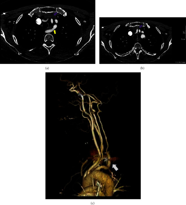 Aortosternal Venous Compression: A Review of Two Cases.