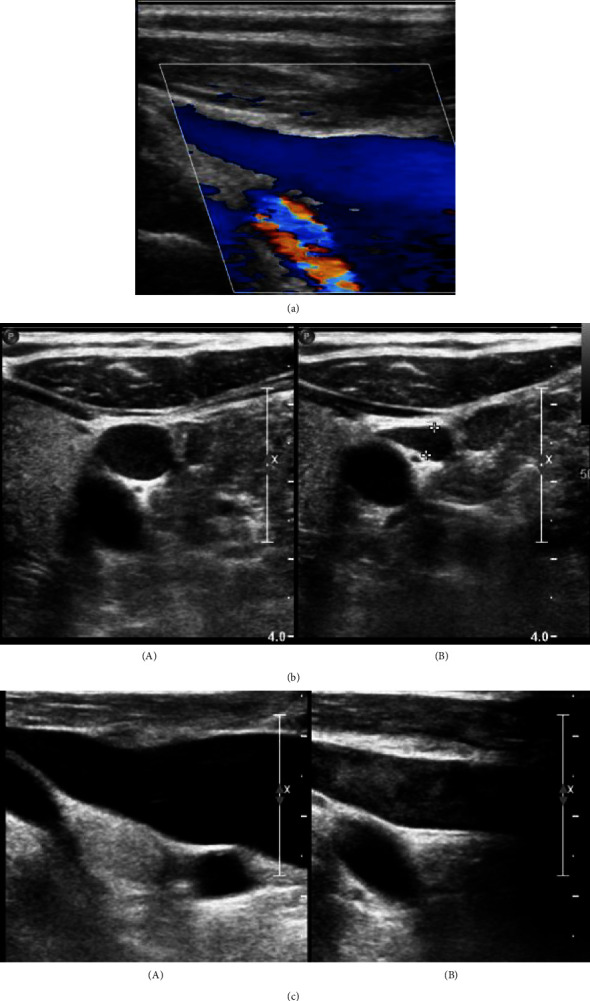 Aortosternal Venous Compression: A Review of Two Cases.