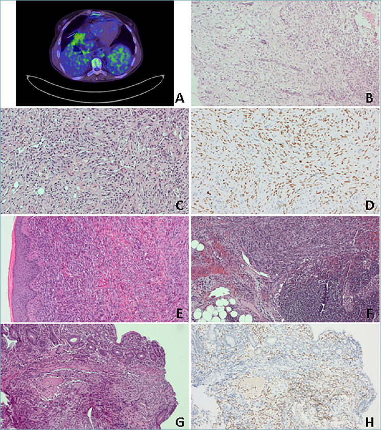 Pleural Kaposi sarcoma: an unusual clinical case.