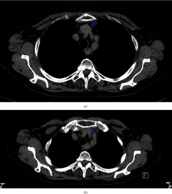 Aortosternal Venous Compression: A Review of Two Cases.