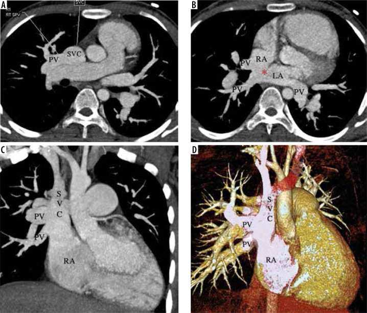 Partial anomalous pulmonary venous connection: state-of-the-art review with assessment using a multidetector computed tomography angiography.