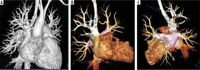 Partial anomalous pulmonary venous connection: state-of-the-art review with assessment using a multidetector computed tomography angiography.