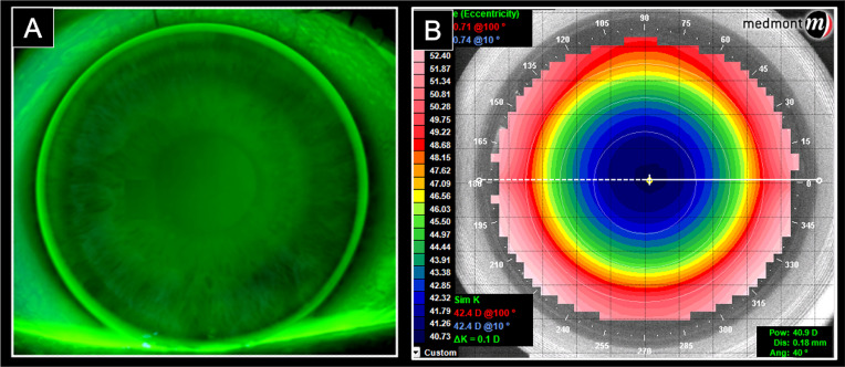 Visual performance with multifocal corneal gas-permeable contact lenses in young adults: A pilot study