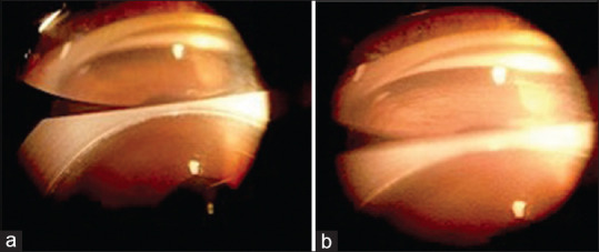 Bilateral Acute Iris Transillumination without Prior Systemic Antibiotics.