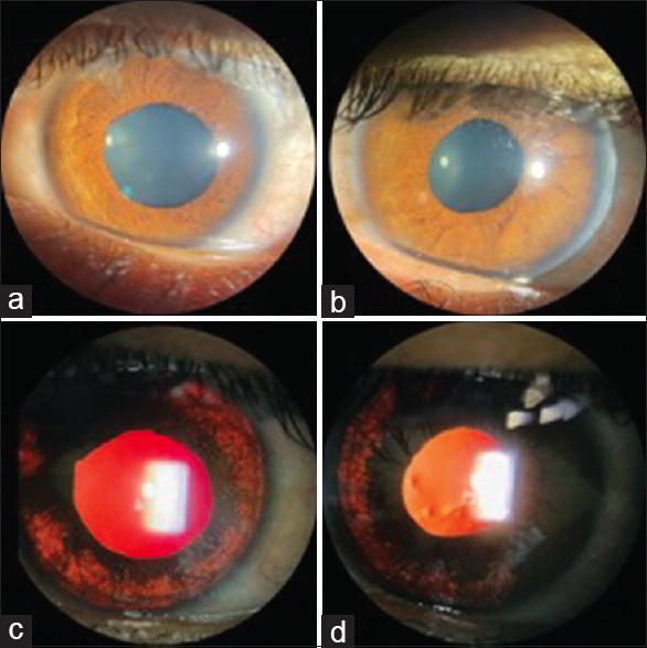 Bilateral Acute Iris Transillumination without Prior Systemic Antibiotics.