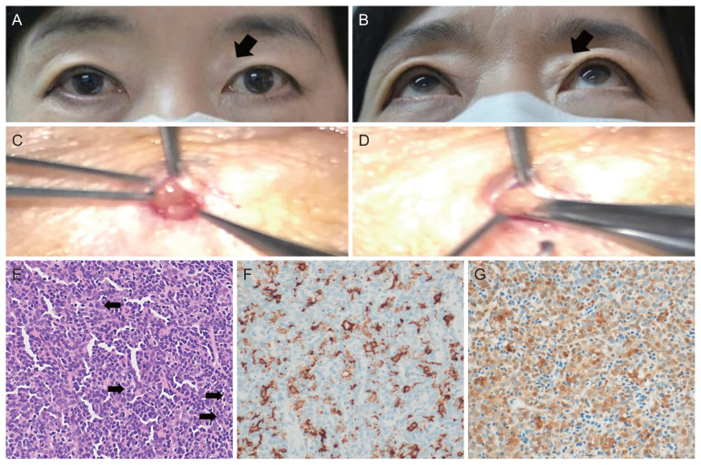 A Rare Case of Upper Eyelid Langerhans Cell Histiocytosis.