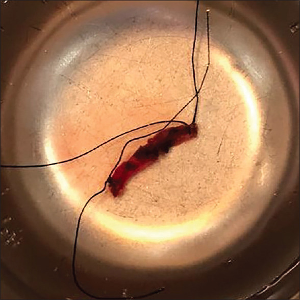 Lacrimal Canalicular Bypass Surgery with Autologous Superficial Temporal Artery Graft.