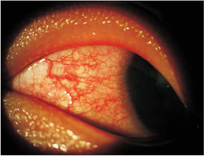 The Clinical Manifestation of p.Asp50Asn Heterozygous Mutation of <i>GJB2</i> Gene in 3 Members of a Family Is Similar to That of Clouston Syndrome.