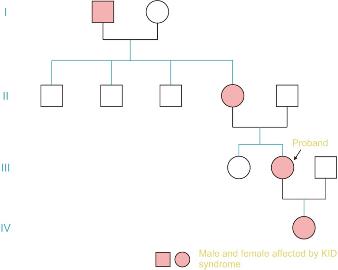 The Clinical Manifestation of p.Asp50Asn Heterozygous Mutation of <i>GJB2</i> Gene in 3 Members of a Family Is Similar to That of Clouston Syndrome.