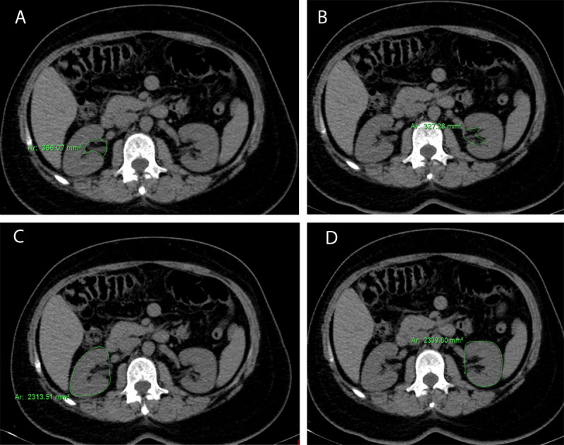 Measurement of the Surface Area of the Renal Sinus Fat Using MDCT: Correlation with Presence and Severity of Essential Hypertension and Body Mass Index.