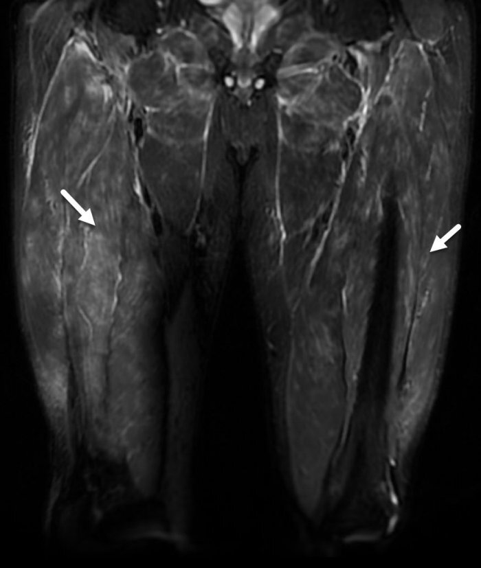 A Unique Case of Myositis.