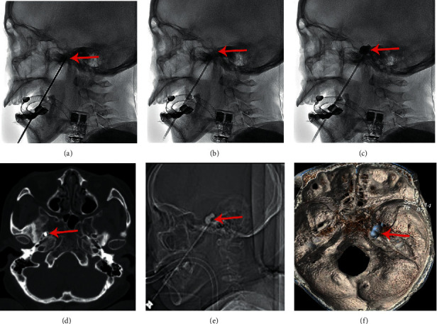 Continuous Intra-Arterial Blood Pressure Monitoring Improves the Efficiency of Percutaneous Balloon Compression of the Trigeminal Ganglion for Trigeminal Neuralgia.