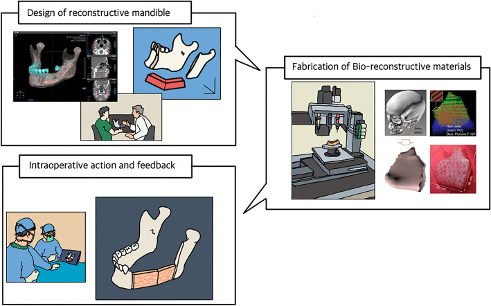 The comprehensive on-demand 3D bio-printing for composite reconstruction of mandibular defects.