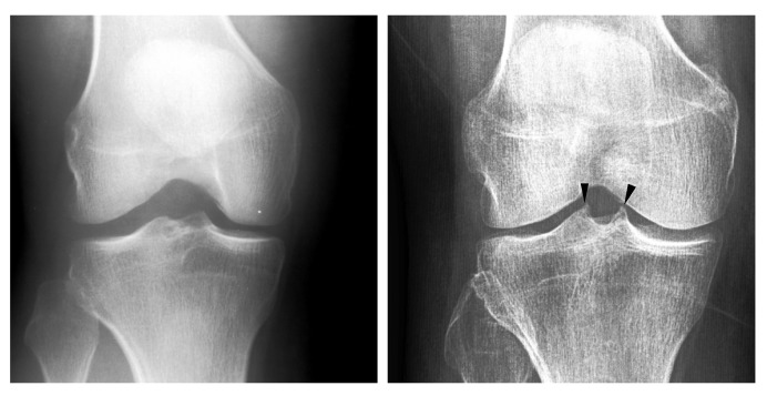 An Automatic Method for Assessing Spiking of Tibial Tubercles Associated with Knee Osteoarthritis.