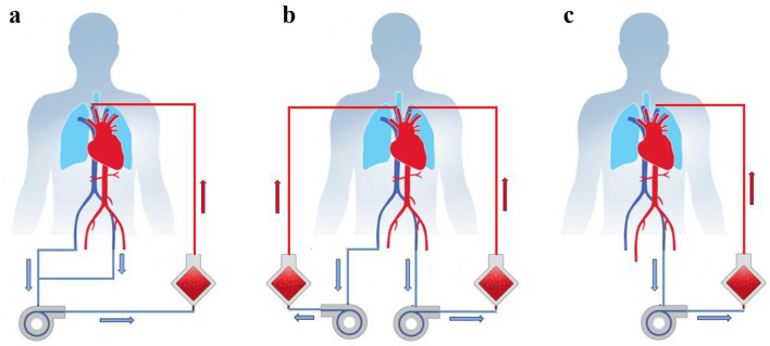 Be Patient: Prolonged Extracorporeal Membrane Oxygenation Support Including Full System Switch With Favorable Outcome.