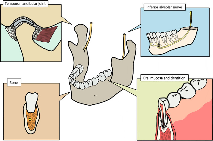 The comprehensive on-demand 3D bio-printing for composite reconstruction of mandibular defects.