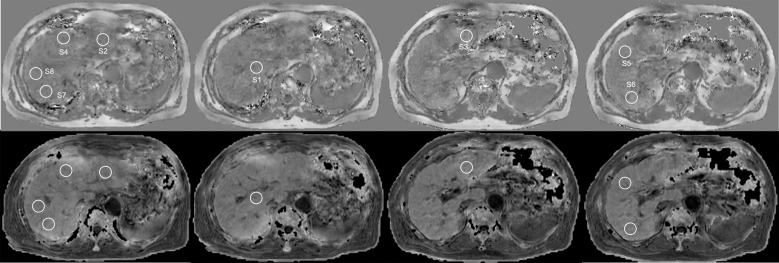 Quantitative Susceptibility Mapping versus R2*-based Histogram Analysis for Evaluating Liver Fibrosis: Preliminary Results.