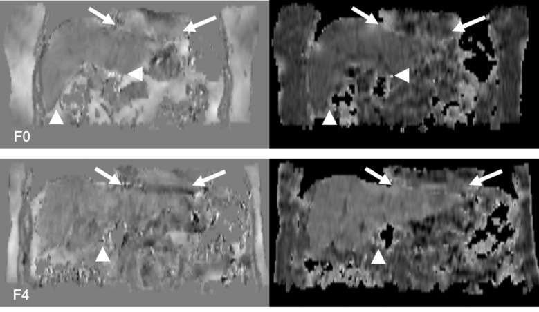 Quantitative Susceptibility Mapping versus R2*-based Histogram Analysis for Evaluating Liver Fibrosis: Preliminary Results.