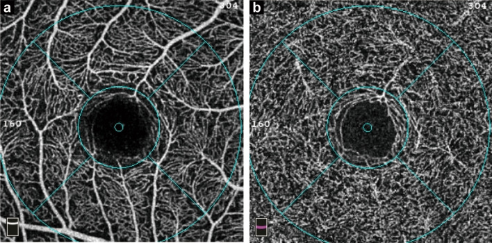 Age- and sex-related differences in the retinal capillary plexus in healthy Chinese adults.