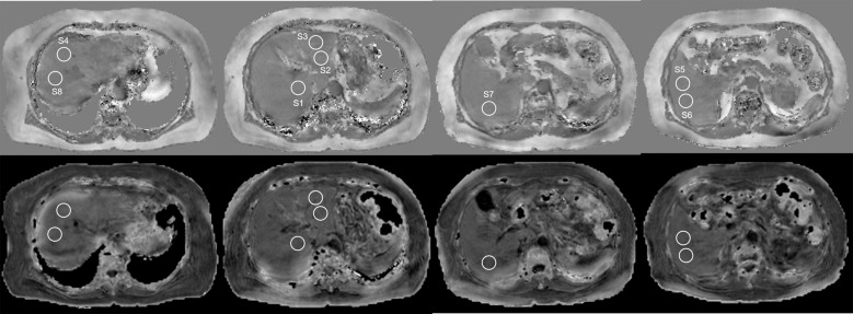 Quantitative Susceptibility Mapping versus R2*-based Histogram Analysis for Evaluating Liver Fibrosis: Preliminary Results.